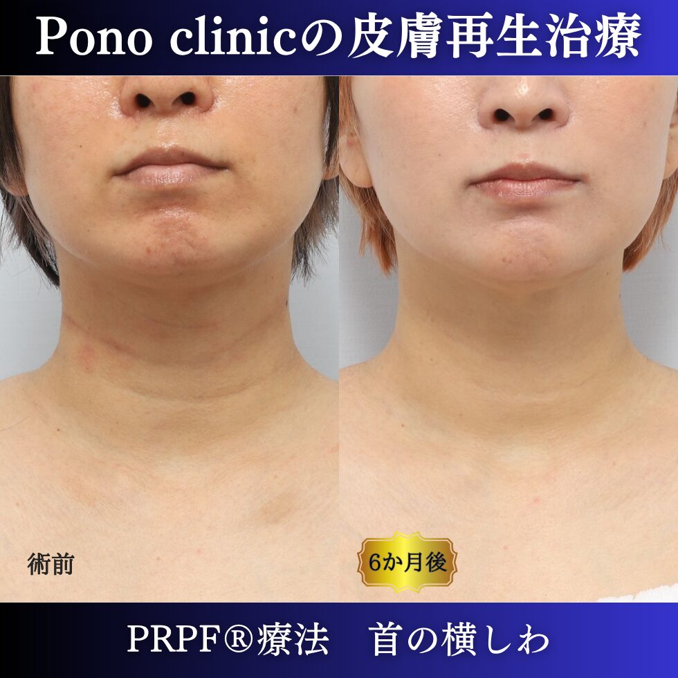 首のシワ、しわ治療、PRPF®、30代の症例 (5)