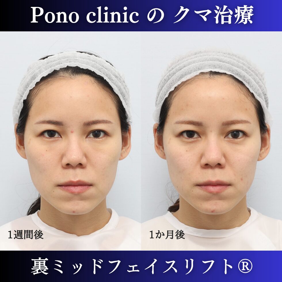 20代女性の裏ミッドフェイスリフト術後1週間と1か月の腫れの経過