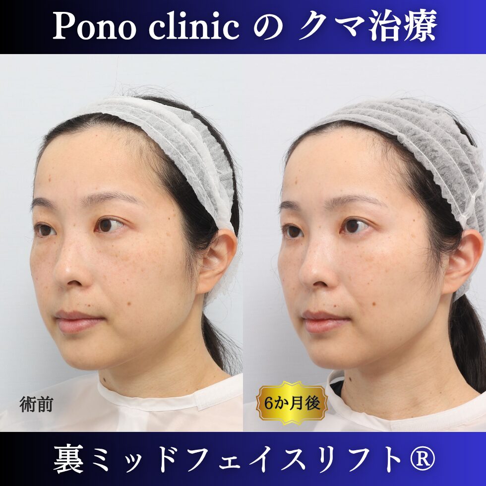 裏ミッドフェイスリフト、裏ハムラ、骨膜下リフト、クマ治療、30代の症例 (2)