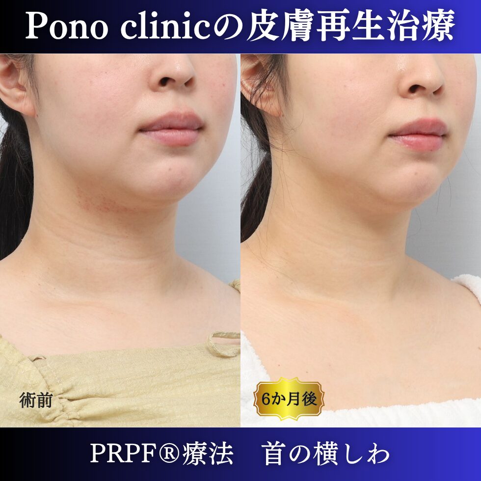 首のしわ、シワ治療、PRPF®療法、30代の症例 (2)