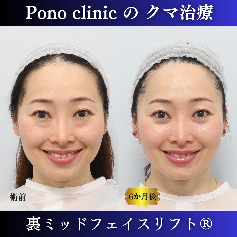 クマ治療、裏ミッドフェイスリフト、裏ハムラ、骨膜下リフト、40代の症例 (4)