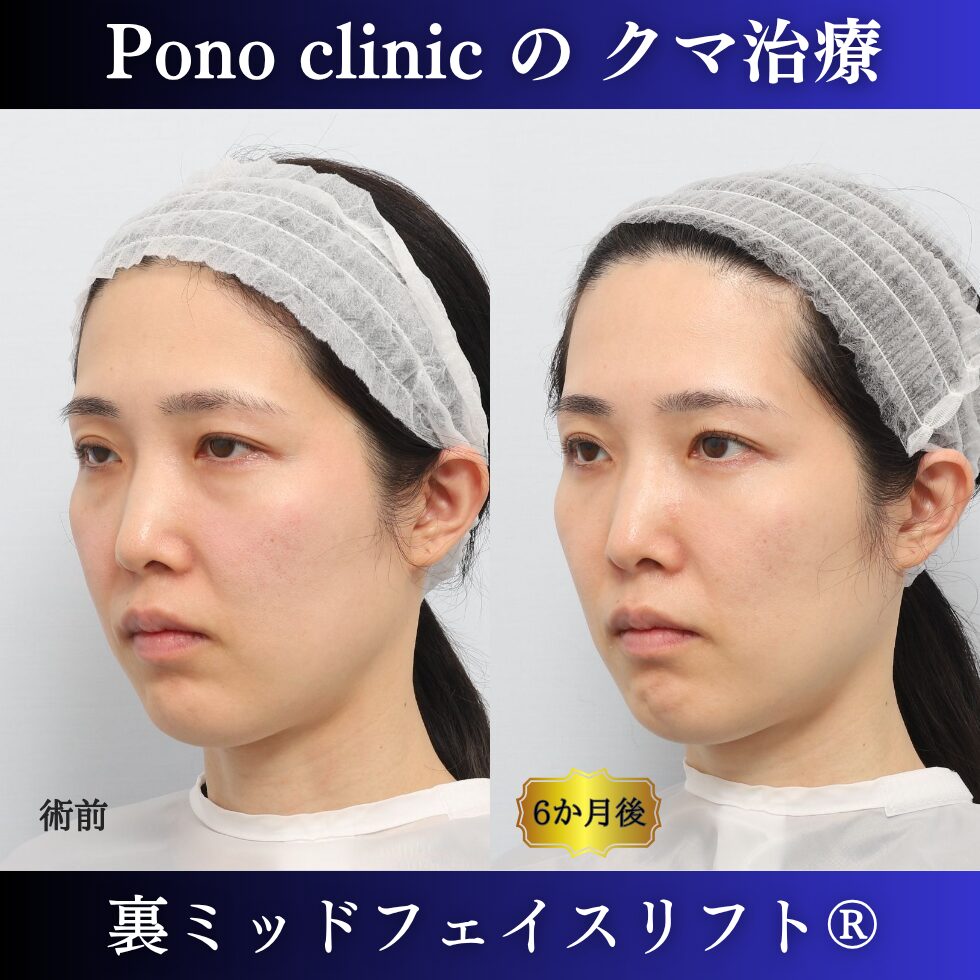 裏ミッドフェイスリフト®、目の下のクマ治療、裏ハムラ、骨膜下リフト、30代の症例 (4)