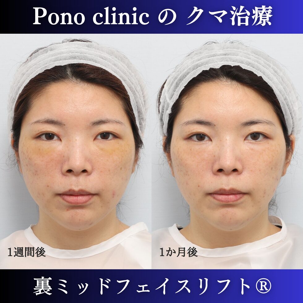目の下のクマ治療、裏ハムラ、骨膜下リフト、裏ミッドフェイスリフト®、30代の症例(1)