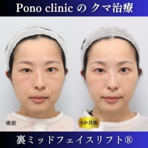 裏ミッドフェイスリフト、裏ハムラ、骨膜下リフト、クマ治療、30代の症例 (7)