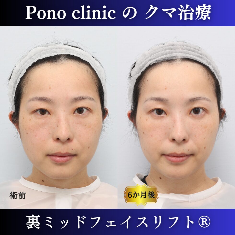 裏ミッドフェイスリフト、裏ハムラ、骨膜下リフト、クマ治療、30代の症例 (7)