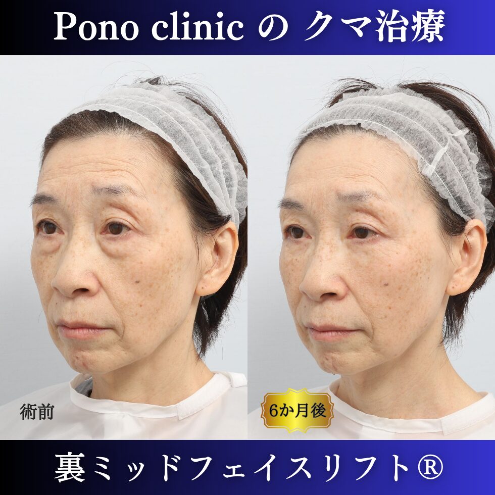 60代女性の裏ミッドフェイスリフト症例 左向き 左が術前 右が術後 頬まで広がる影の改善