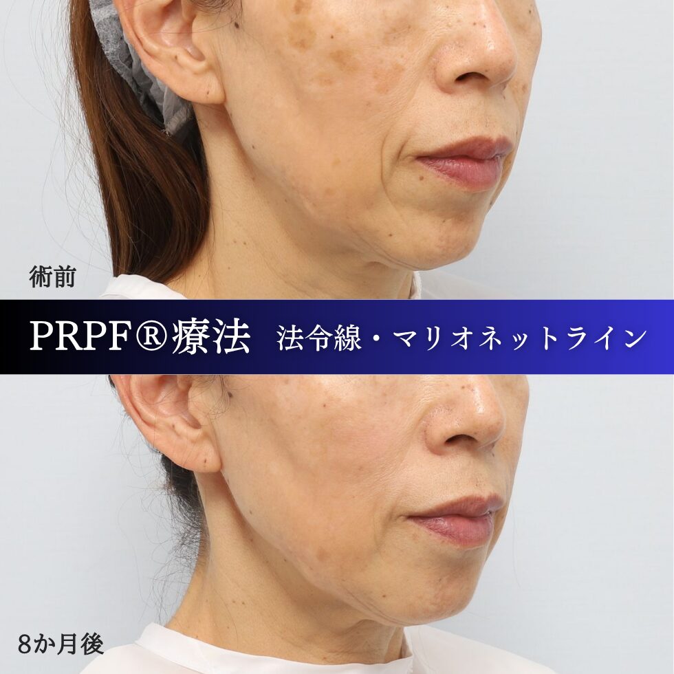 法令線、マリオネットライン、しわ治療、PRPF療法、60代の症例 (1)