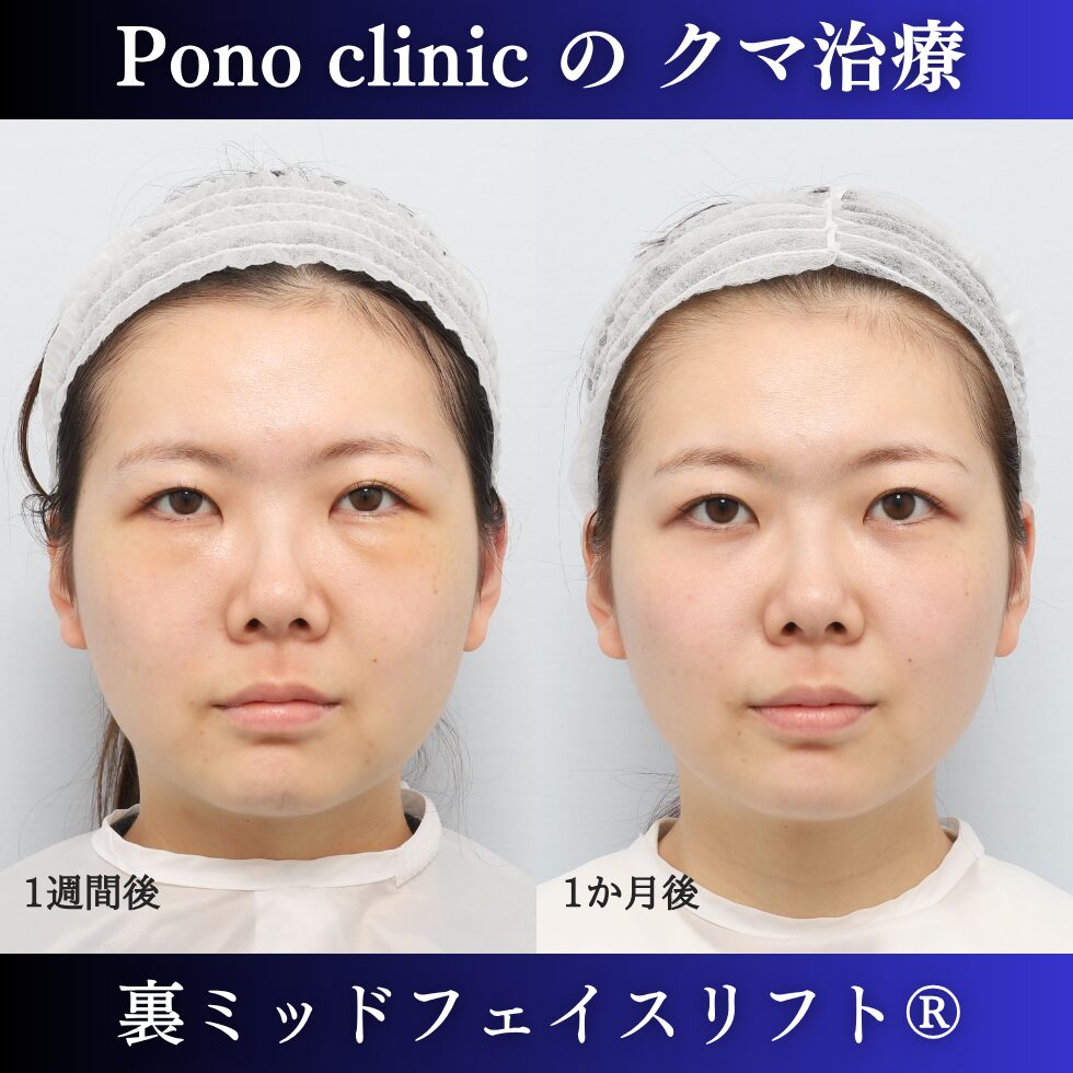 目の下のクマ取り、骨膜下リフト、裏ハムラ、裏ミッドフェイスリフト®、20代の症例 (1)