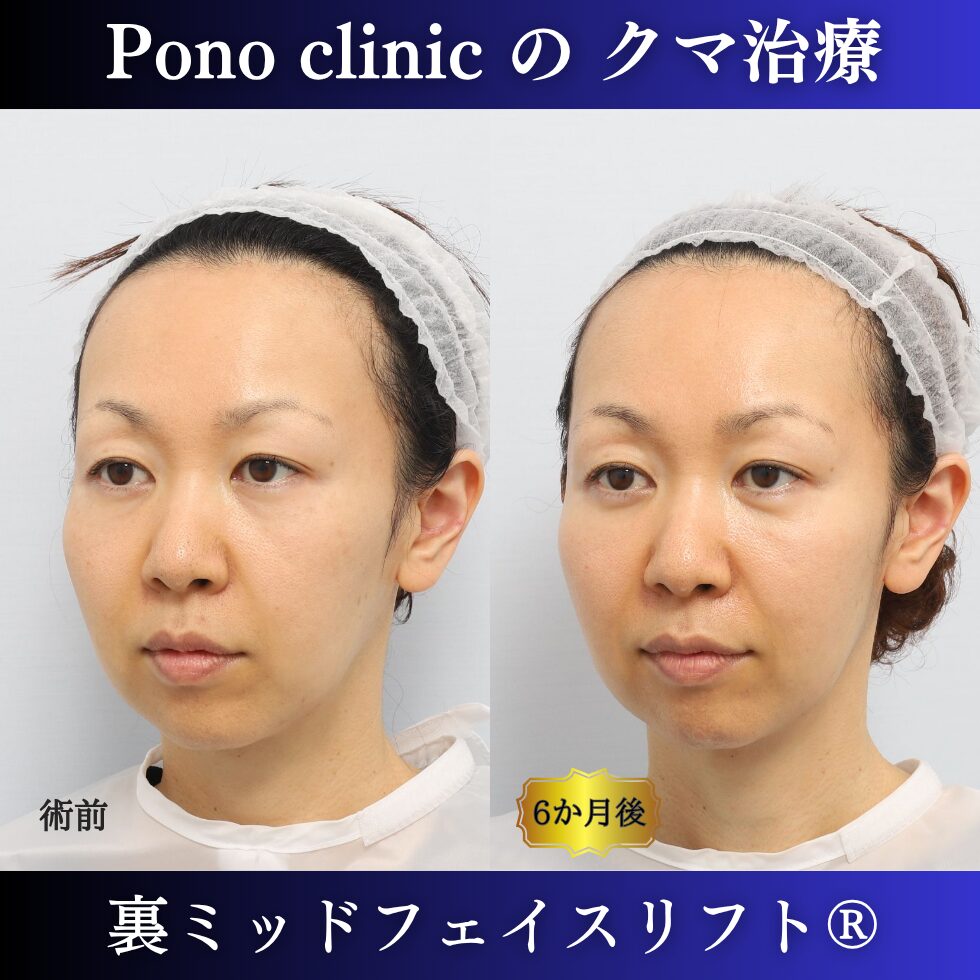 40代女性の裏ミッドフェイスリフト術前と術後6か月の左斜位比較