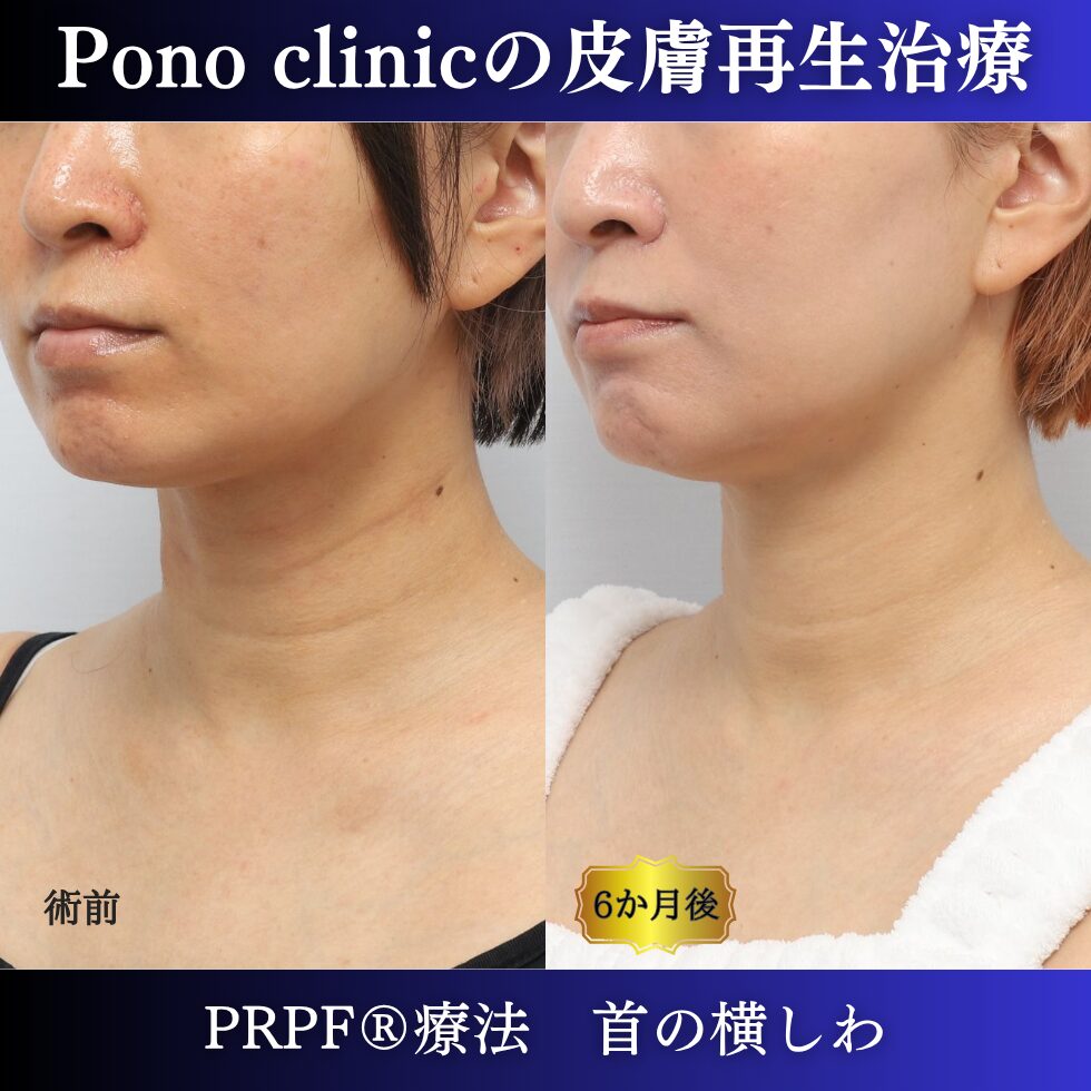 首のシワ、しわ治療、PRPF®、30代の症例 (3)