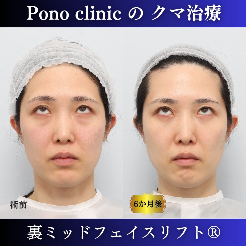 裏ミッドフェイスリフト®、目の下のクマ治療、裏ハムラ、骨膜下リフト、30代の症例 (5)