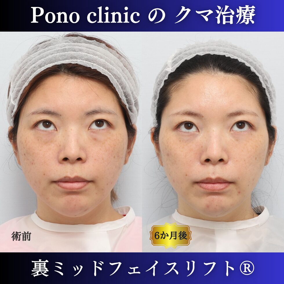 目の下のクマ治療、裏ハムラ、骨膜下リフト、裏ミッドフェイスリフト®、30代の症例(5)