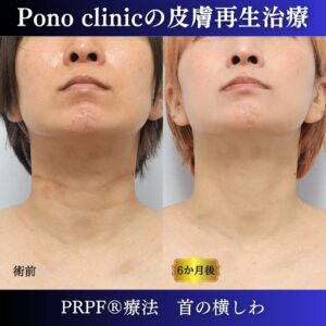 首のシワ、しわ治療、PRPF®、30代の症例 (6)