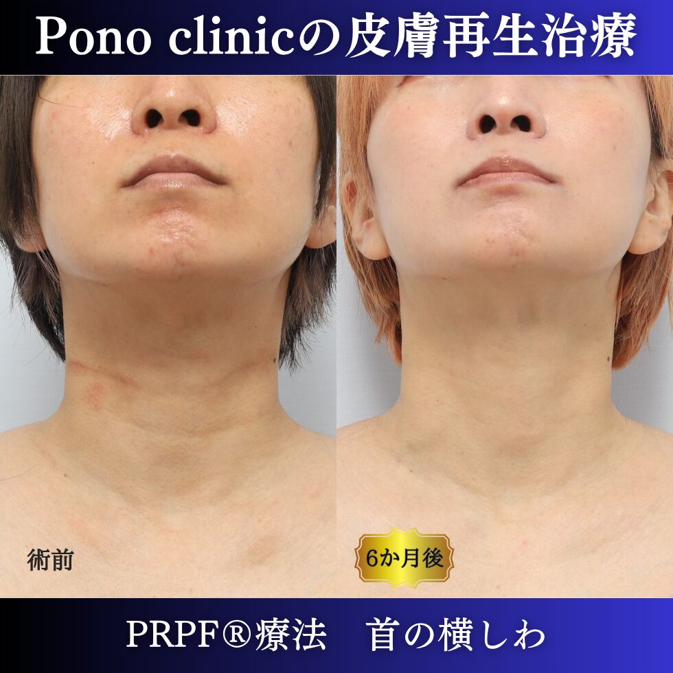 首のシワ、しわ治療、PRPF®、30代の症例 (6)