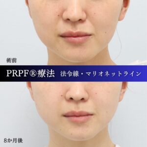 法令線、マリオネットライン、しわ治療、PRPF療法、30代の症例 (3)