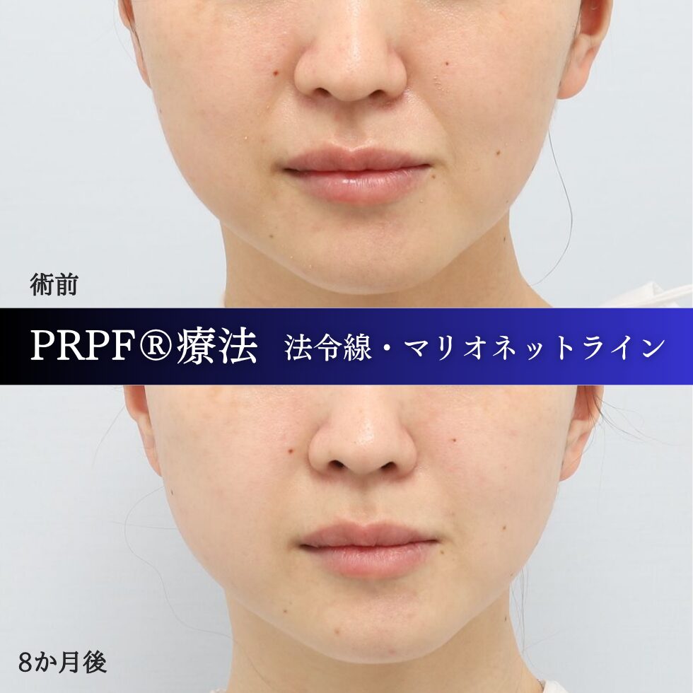 法令線、マリオネットライン、しわ治療、PRPF療法、30代の症例 (3)