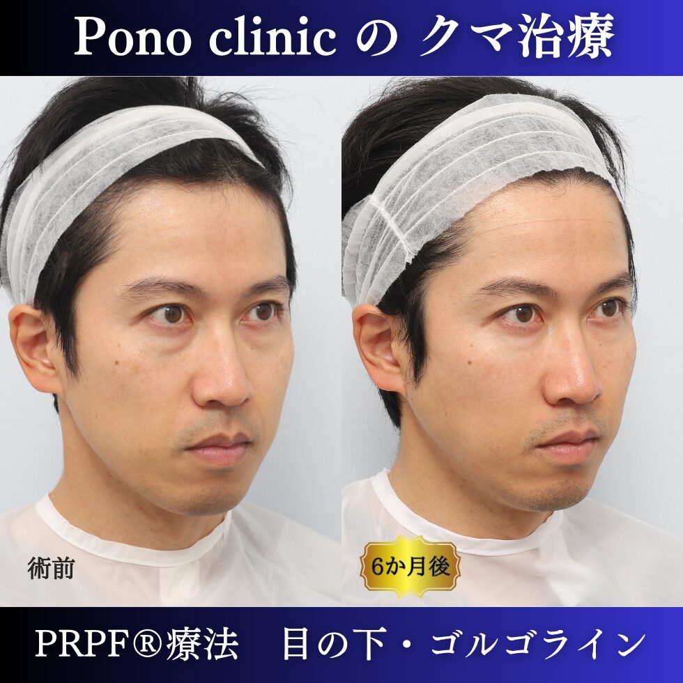 クマ治療、PRPF®療法、目の下、ゴルゴライン、40代男性の症例 (1)