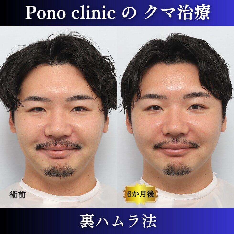 目の下のクマ治療、裏ハムラ法、30代男性の症例 (6)