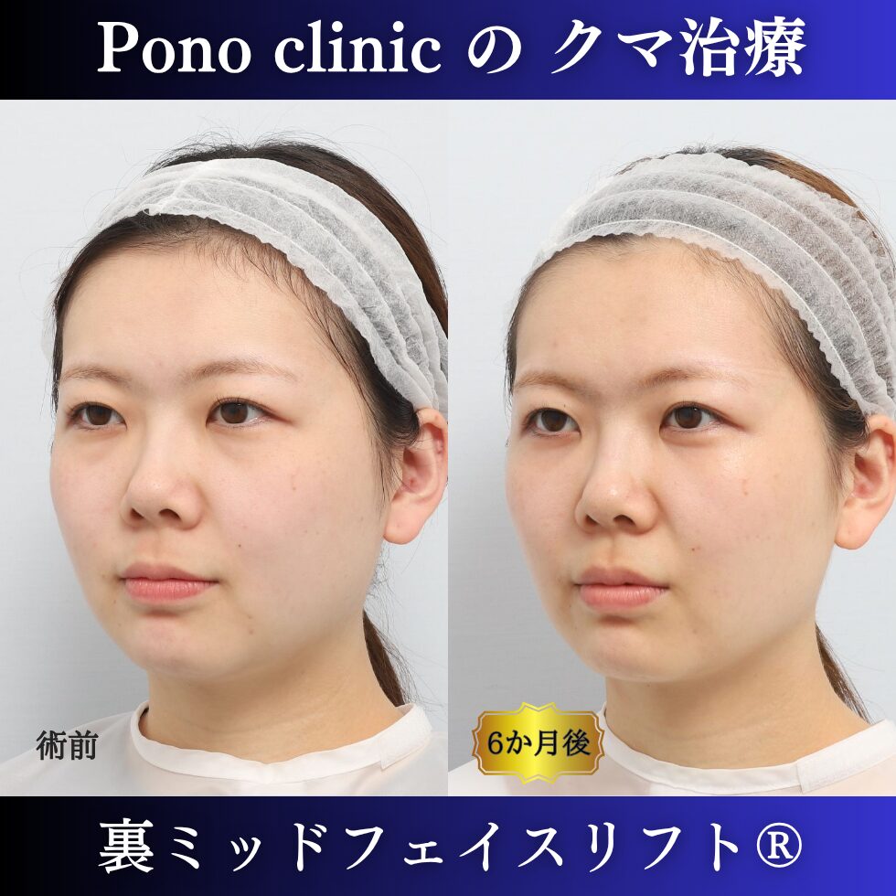 目の下のクマ取り、骨膜下リフト、裏ハムラ、裏ミッドフェイスリフト®、20代の症例 (3)