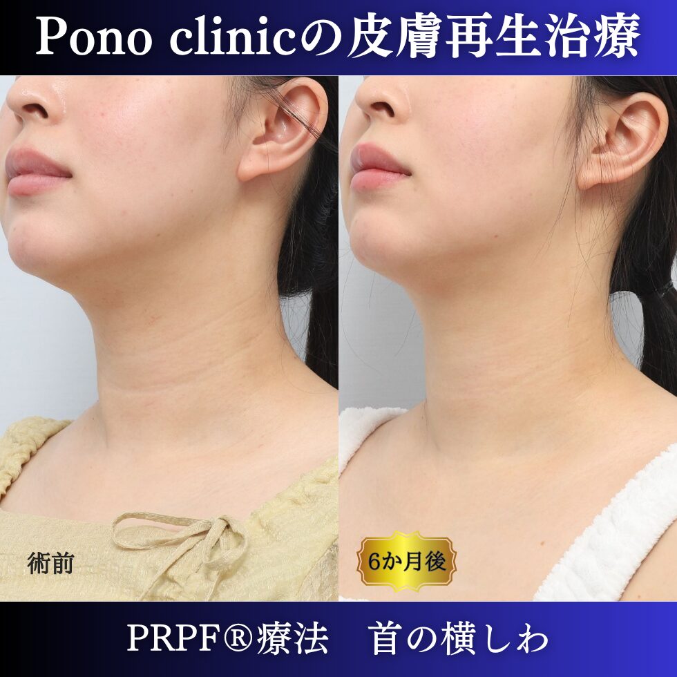 首のしわ、シワ治療、PRPF®療法、30代の症例 (3)
