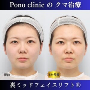 目の下のクマ取り、骨膜下リフト、裏ハムラ、裏ミッドフェイスリフト®、20代の症例 (7)