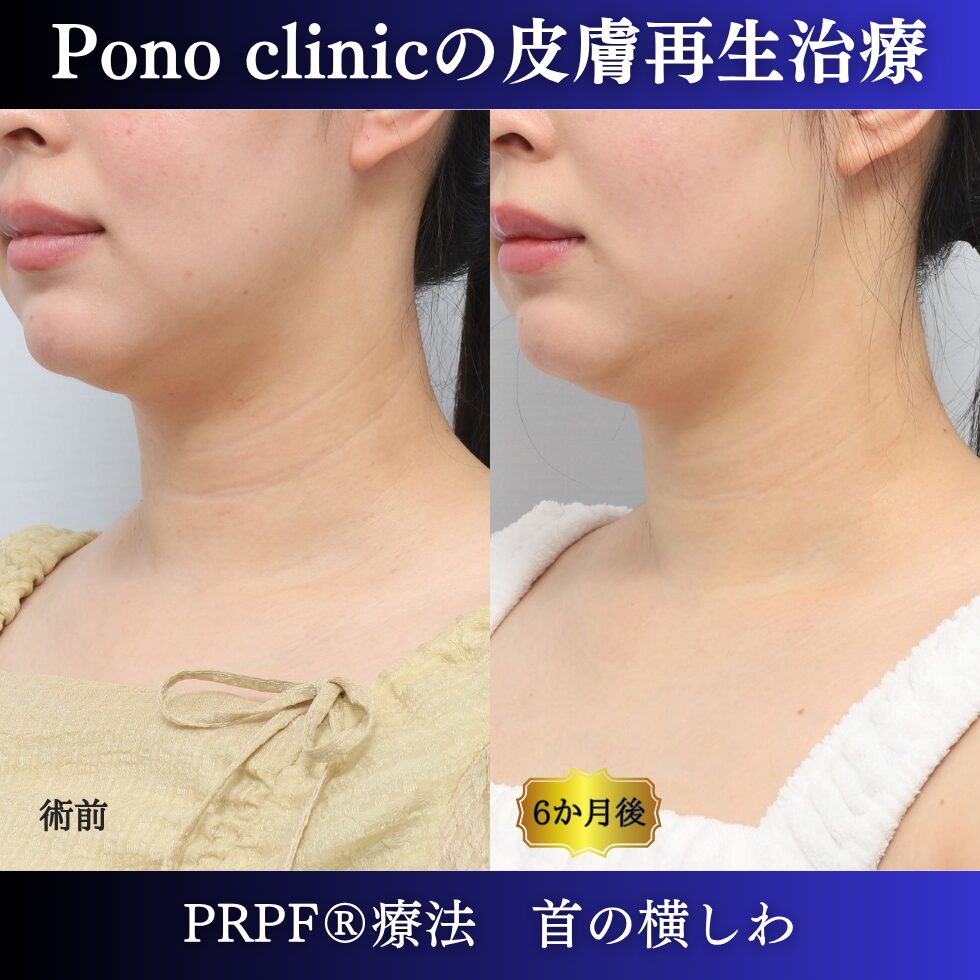 首のしわ、シワ治療、PRPF®療法、30代の症例 (4)