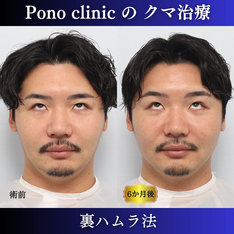 目の下のクマ治療、裏ハムラ法、30代男性の症例 (4)