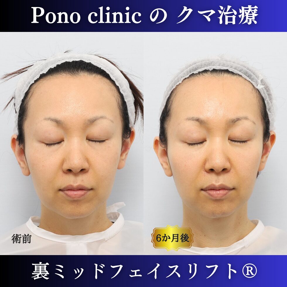 40代女性の裏ミッドフェイスリフト術前と術後6か月の閉眼比較
