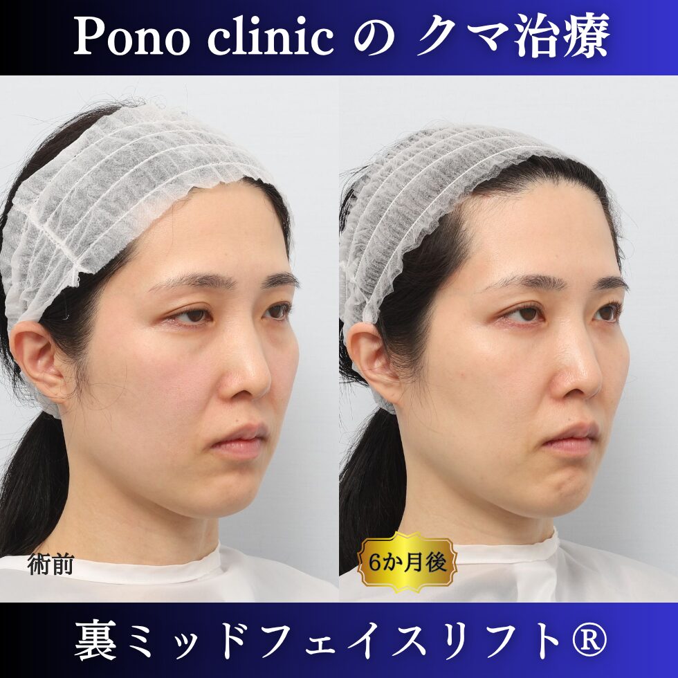裏ミッドフェイスリフト®、目の下のクマ治療、裏ハムラ、骨膜下リフト、30代の症例 (3)