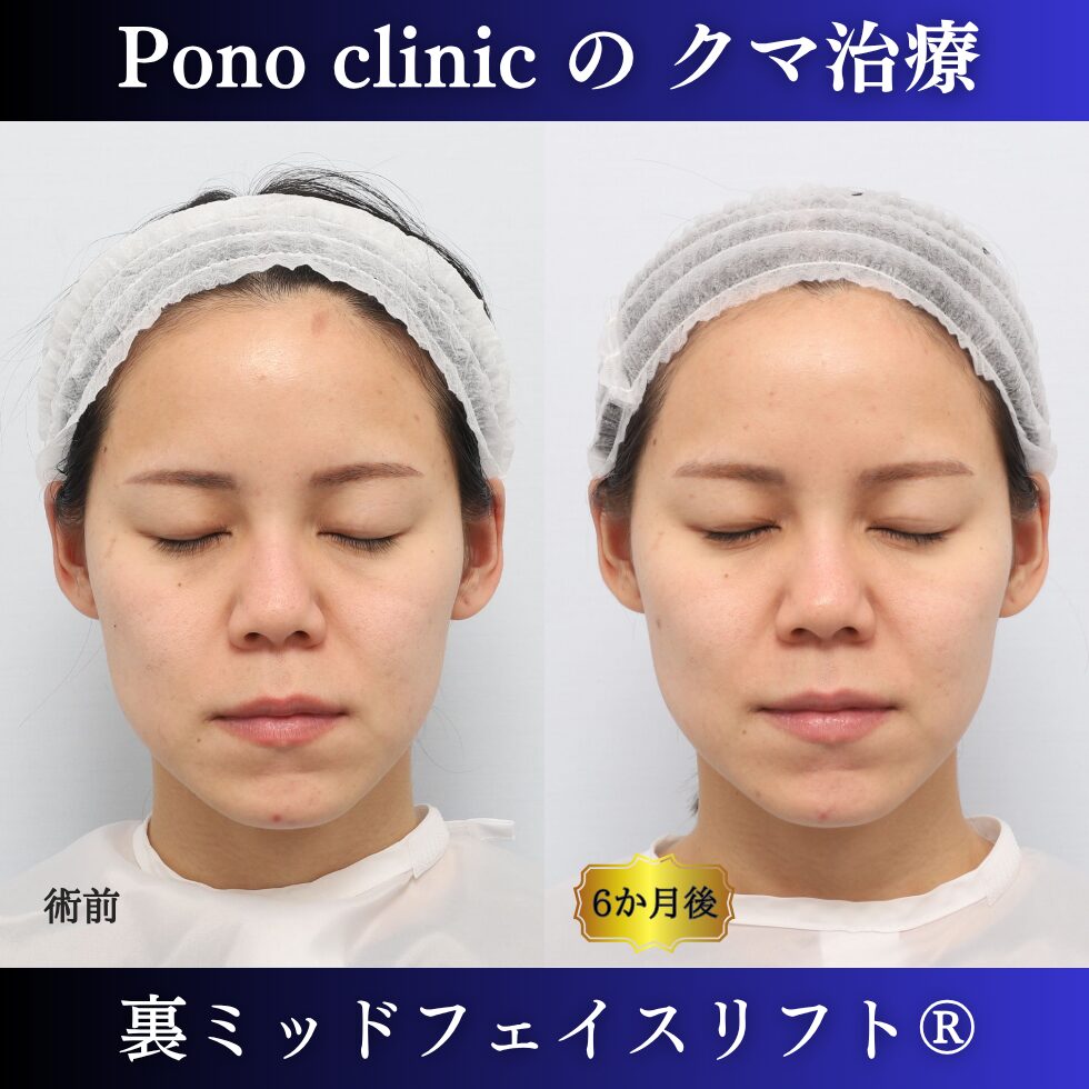 20代女性の裏ミッドフェイスリフト術前と術後6か月の閉眼比較
