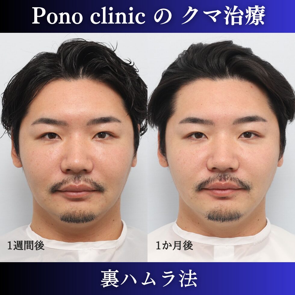 目の下のクマ治療、裏ハムラ法、30代男性の症例 (1)