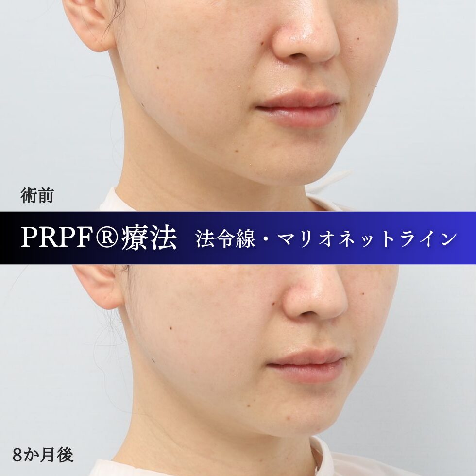 法令線、マリオネットライン、しわ治療、PRPF療法、30代の症例 (1)