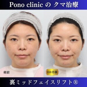 目の下のクマ治療、裏ハムラ、骨膜下リフト、裏ミッドフェイスリフト®、30代の症例(4)