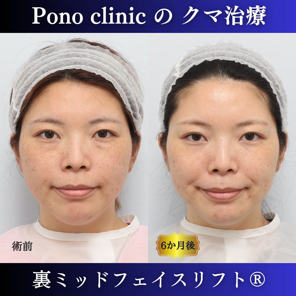 目の下のクマ治療、裏ハムラ、骨膜下リフト、裏ミッドフェイスリフト®、30代の症例(4)