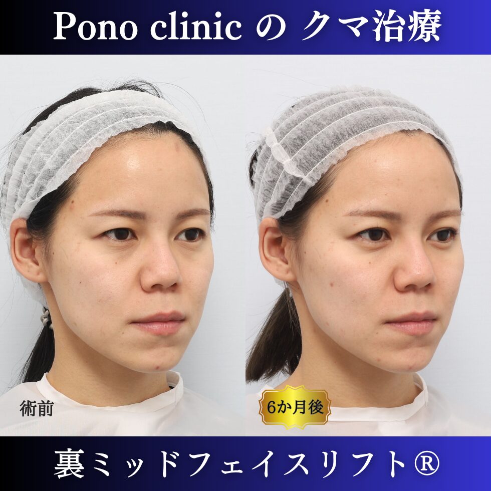 20代女性の裏ミッドフェイスリフト術前と術後6か月の右斜位比較