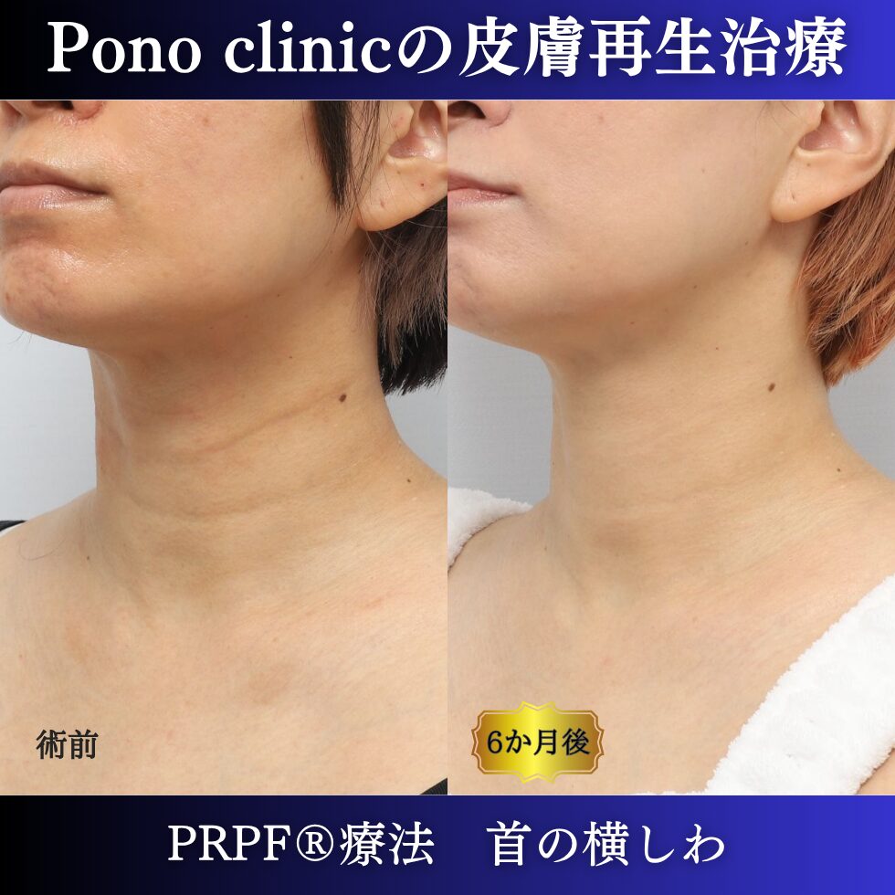 首のシワ、しわ治療、PRPF®、30代の症例 (4)