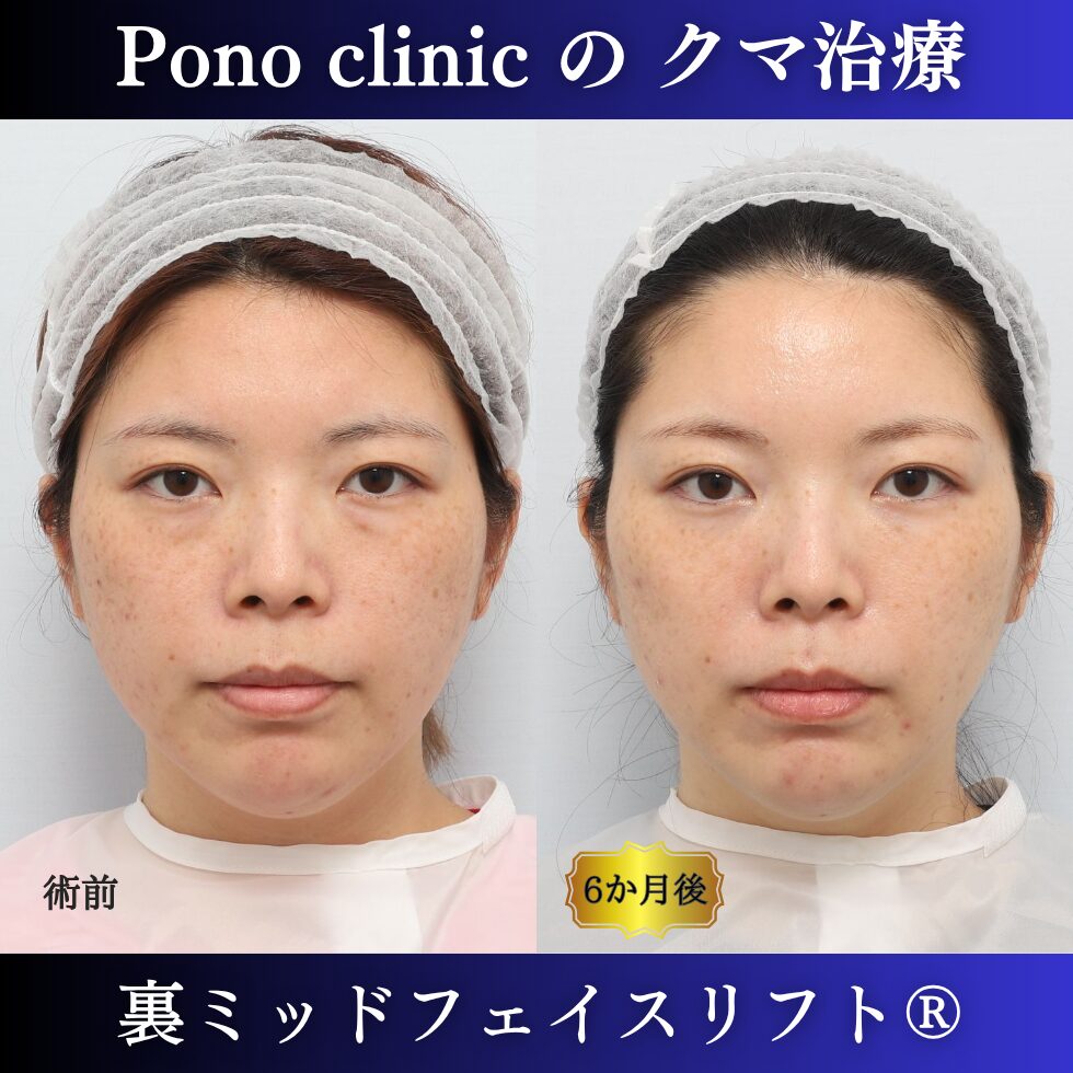 目の下のクマ治療、裏ハムラ、骨膜下リフト、裏ミッドフェイスリフト®、30代の症例(7)