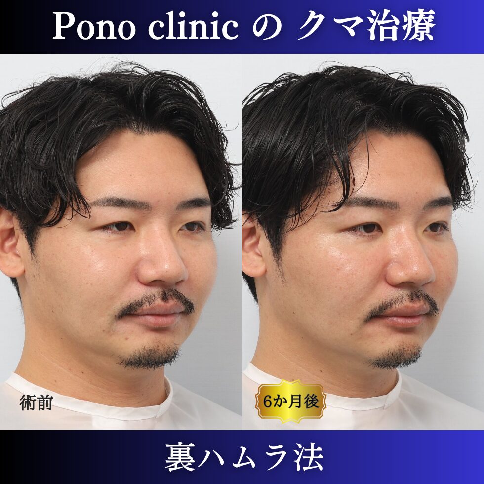 目の下のクマ治療、裏ハムラ法、30代男性の症例 (2)