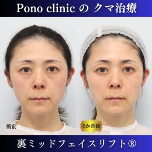 目の下のクマ治療、裏ハムラ、骨膜下リフト、裏ミッドフェイスリフト®、40代の症例 (6)