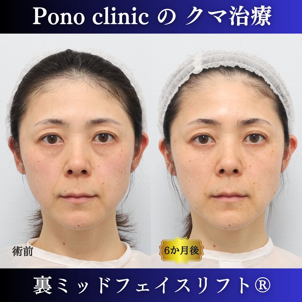 目の下のクマ治療、裏ハムラ、骨膜下リフト、裏ミッドフェイスリフト®、40代の症例 (6)