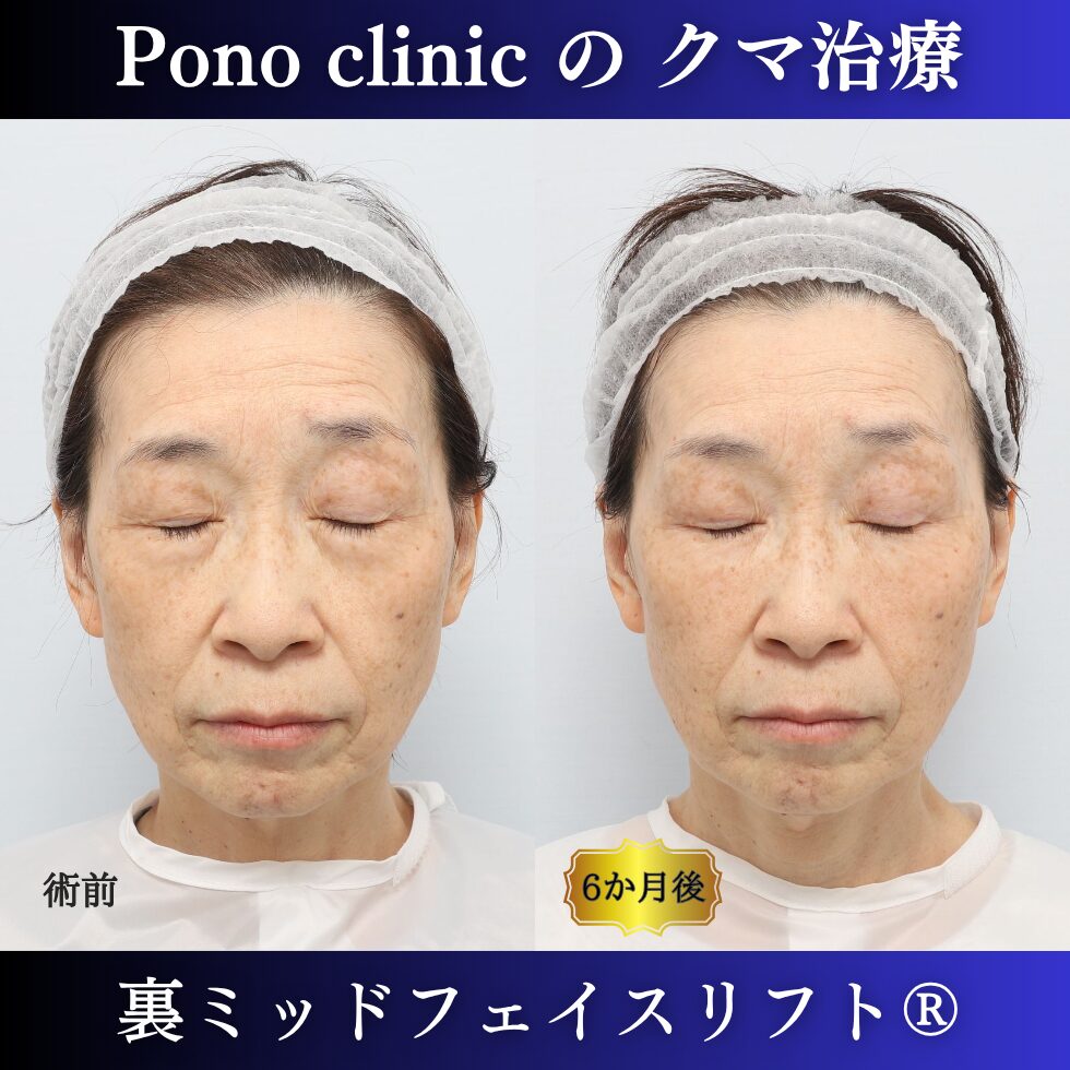 60代女性の裏ミッドフェイスリフト症例 閉眼 左が術前 右が術後 下まぶたの自然さと皮膚表面の比較