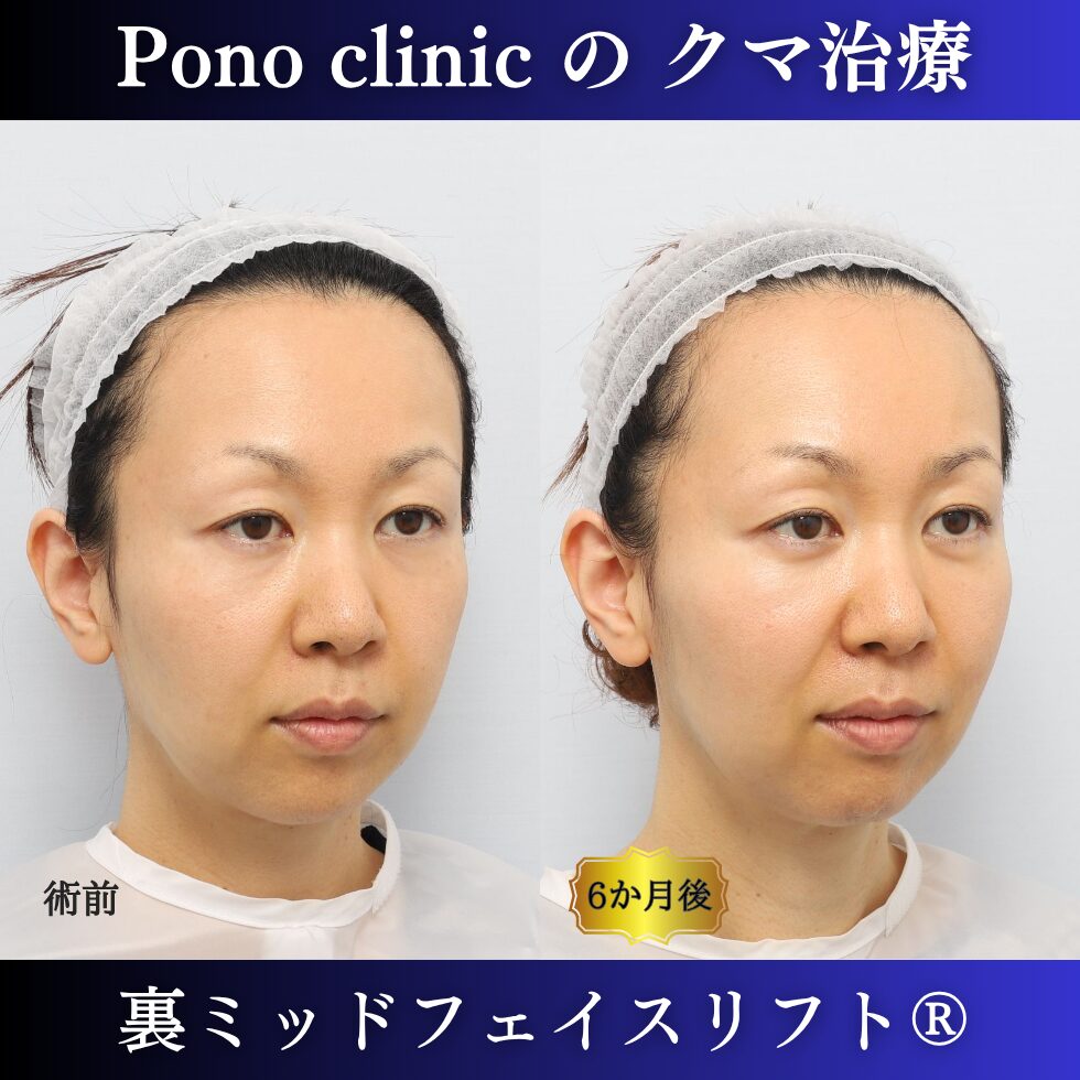 40代女性の裏ミッドフェイスリフト術前と術後6か月の右斜位比較