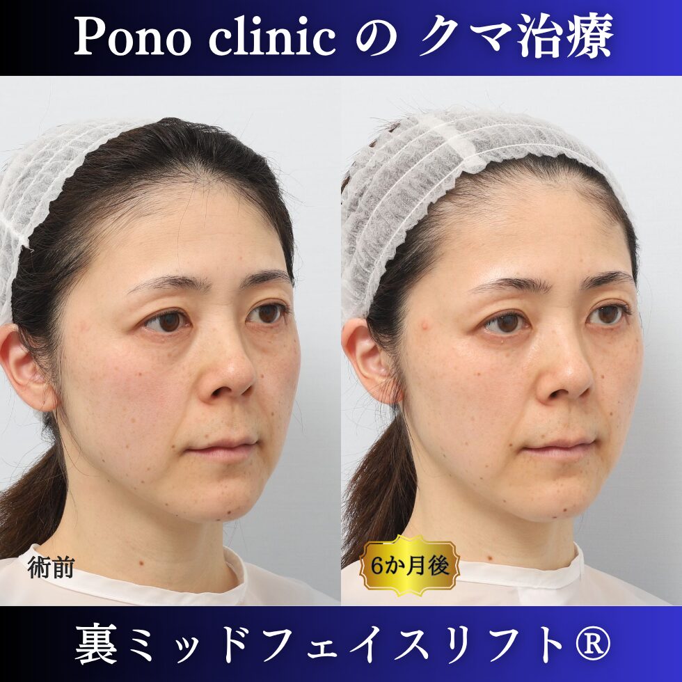 目の下のクマ治療、裏ハムラ、骨膜下リフト、裏ミッドフェイスリフト®、40代の症例 (2)
