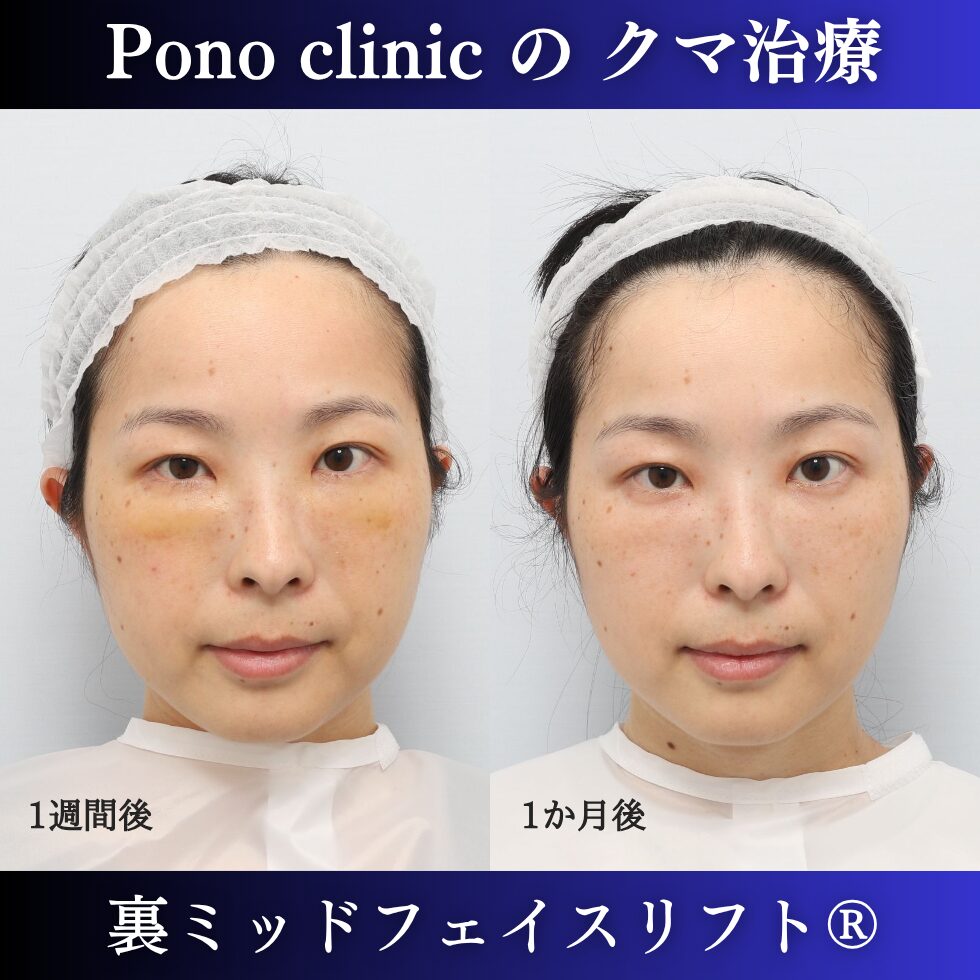 裏ミッドフェイスリフト、裏ハムラ、骨膜下リフト、クマ治療、30代の症例 (1)