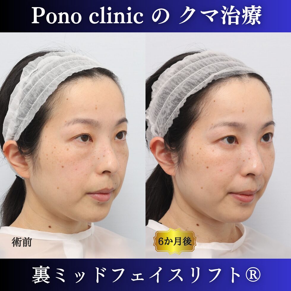 裏ミッドフェイスリフト、裏ハムラ、骨膜下リフト、クマ治療、30代の症例 (4)