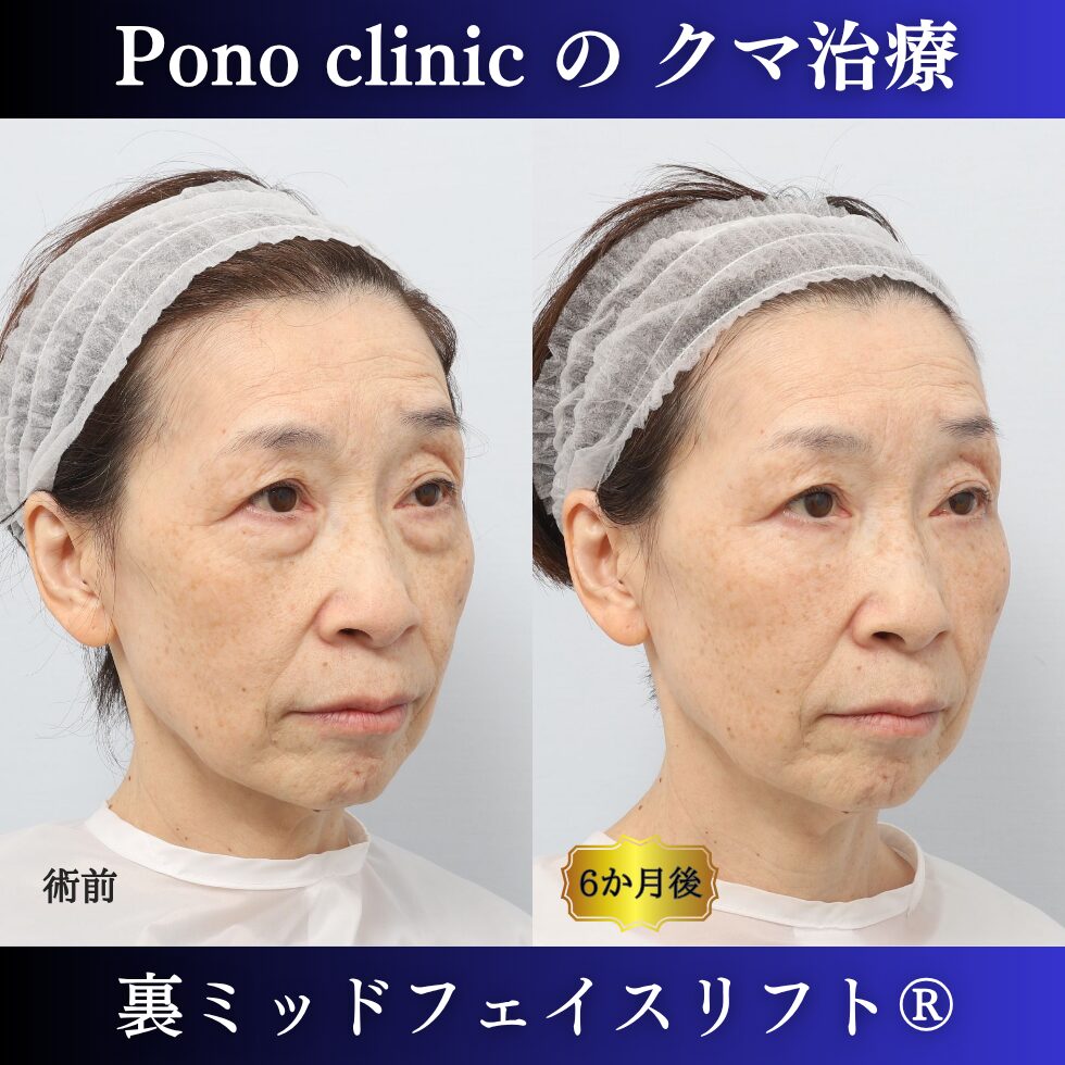 60代女性の裏ミッドフェイスリフト症例 右向き 左が術前 右が術後 目の下から頬の影の変化