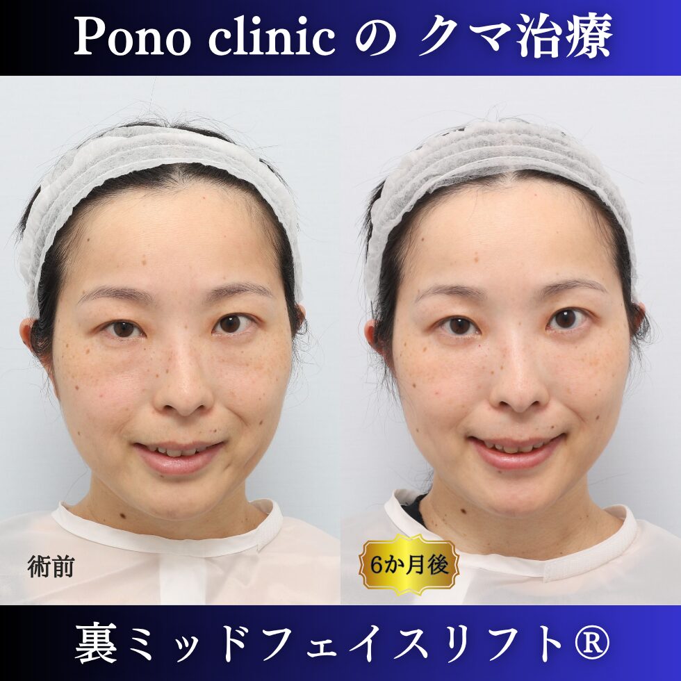 裏ミッドフェイスリフト、裏ハムラ、骨膜下リフト、クマ治療、30代の症例 (5)