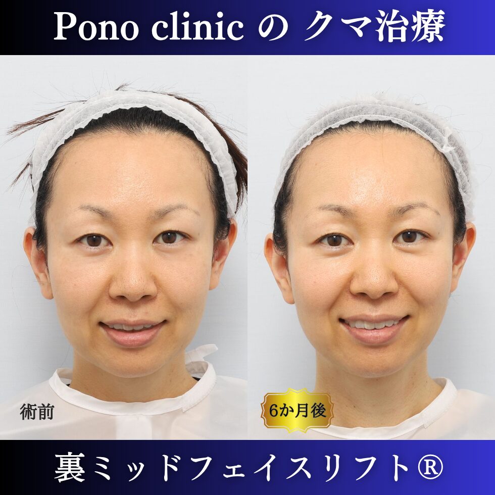 40代女性の裏ミッドフェイスリフト術前と術後6か月の笑顔比較