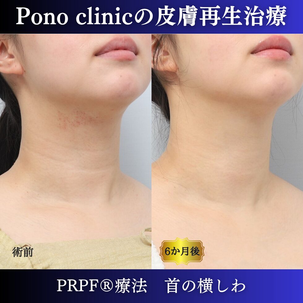 首のしわ、シワ治療、PRPF®療法、30代の症例 (1)