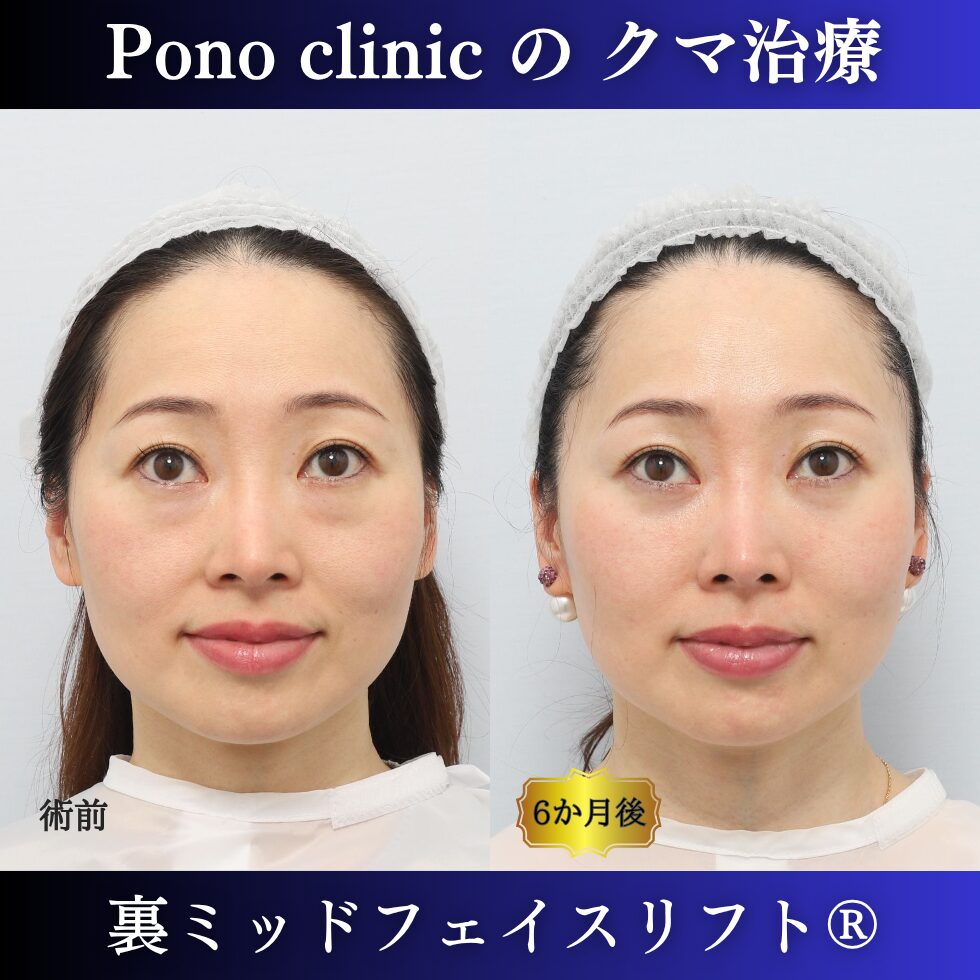 クマ治療、裏ミッドフェイスリフト、裏ハムラ、骨膜下リフト、40代の症例 (5)